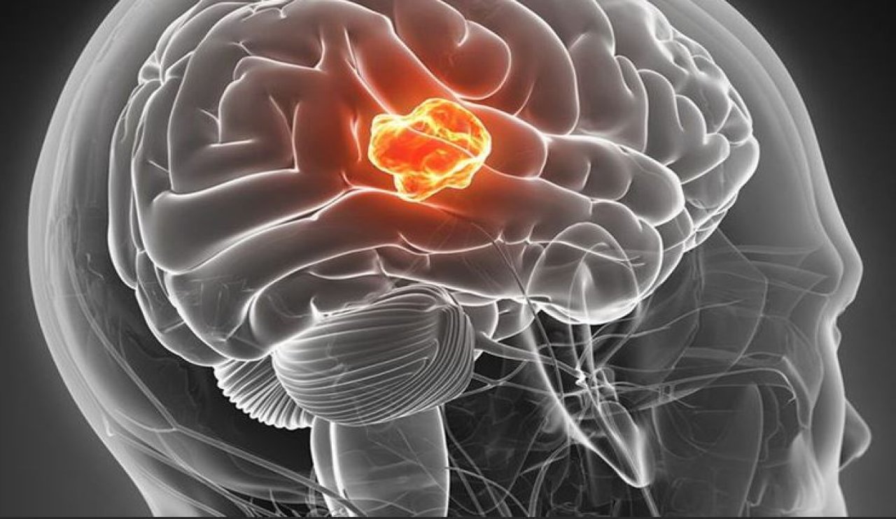 Beyin tümörlerinin belirtileri arasında baş ağrısı da bulunuyor!