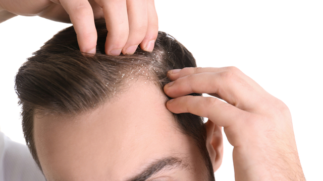 Saç Sağlığı İçin 5 Öneri: Kepeklenmeyi Önlemenin Yolları